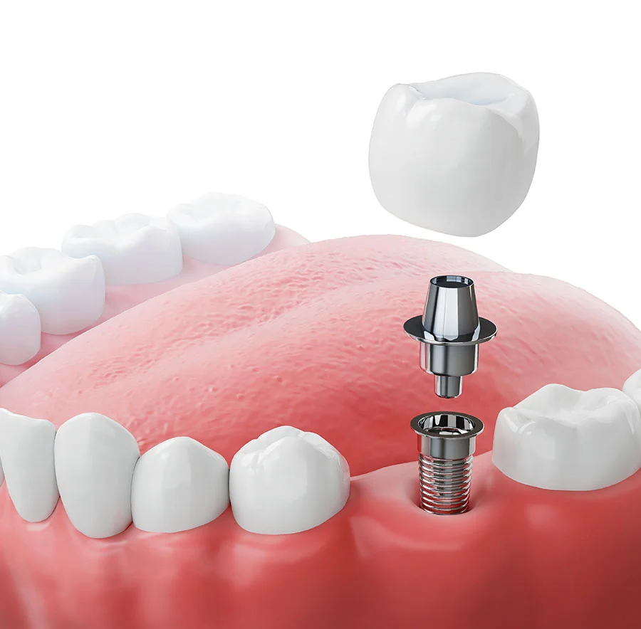 newest-dental-implants-first-step