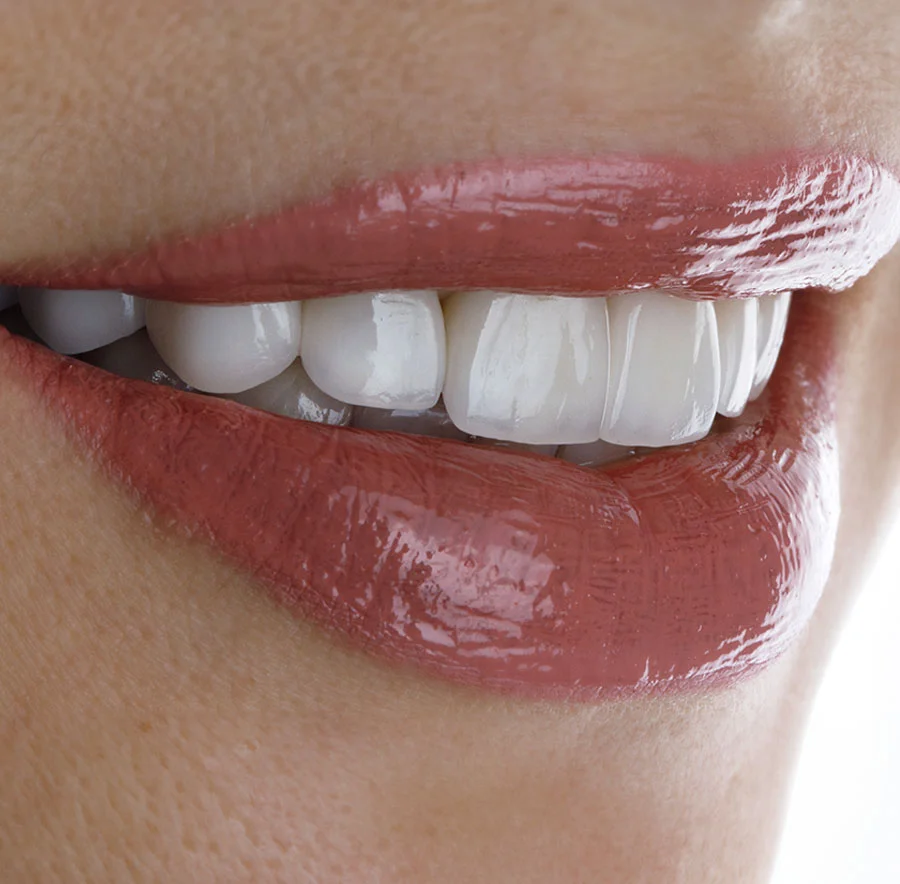 dental-veneers-new-new-new
